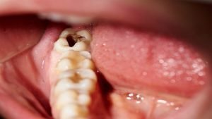 چگونگی پوسیدگی دندان