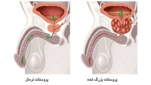 بزرگ شدن پروستات