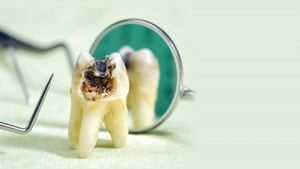 خمیر دندان ضد پوسیدگی دندان