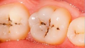 علل و عوامل پوسیدگی دندان