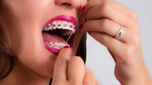 روش کشیدن نخ دندان برای دندان ارتودنسی شده