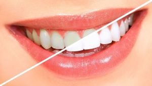 ترکیبات سفید کننده دندان
