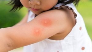 درمان نیش حشرات در کودکان