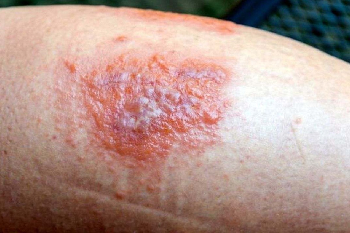 گیاهان دارویی موثر بر عفونت موضعی پوست و فرآورده‌های آنها