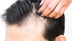 ریزش مو در مردان
