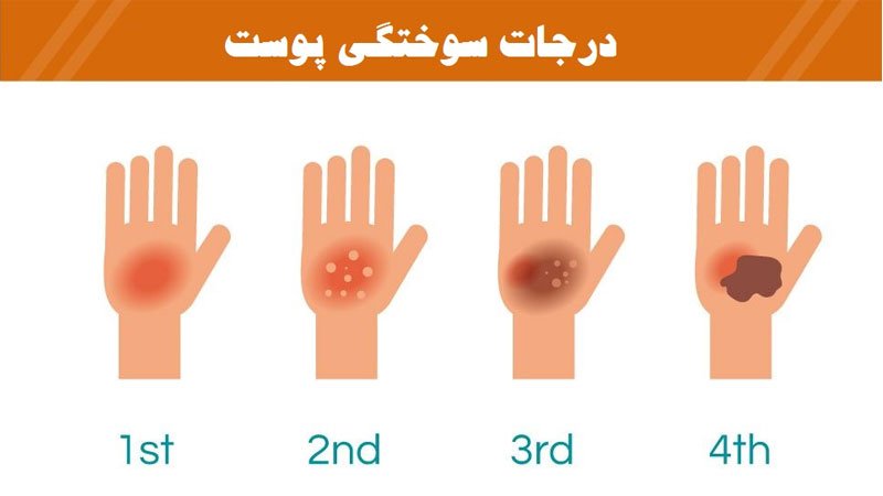 انواع سوختگی