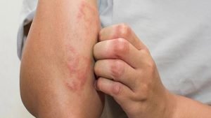 درمان عفونت موضعی پوست