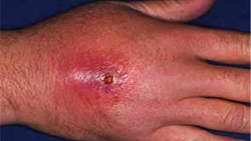 عفونت موضعی پوست