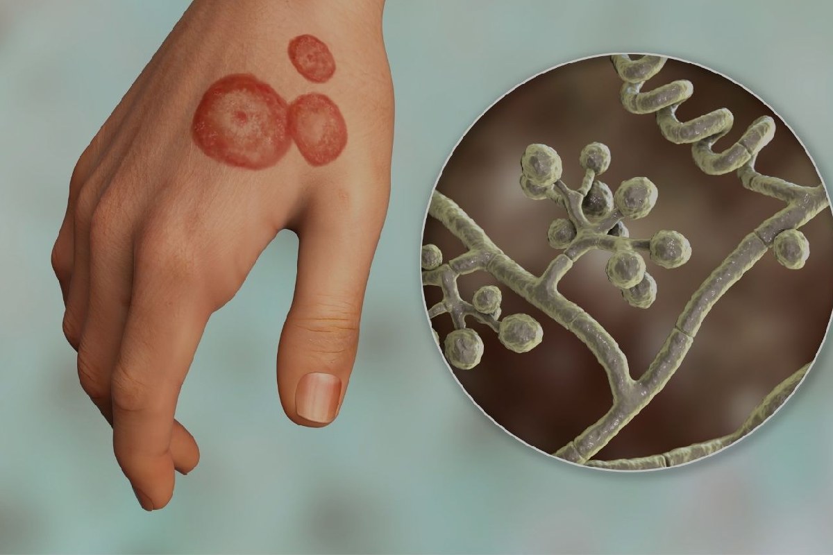 کچلی پوست و راهکارهای درمان آن با ترکیبات گیاهی