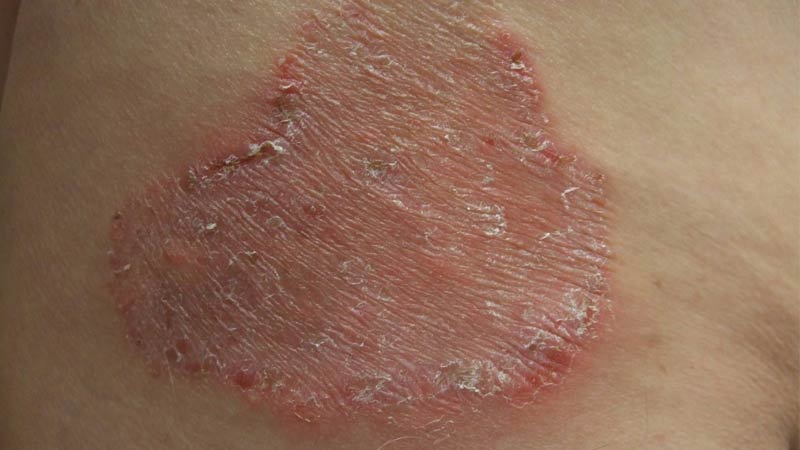 کچلی کشاله ران