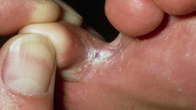 کچلی انگشتان