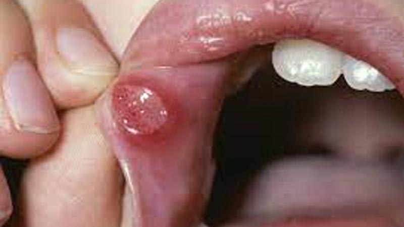 تشخیص آفت دهان