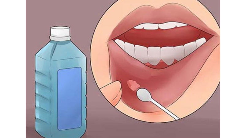 درمان سریع آفت دهان