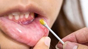 درمان آفت دهان با عسل