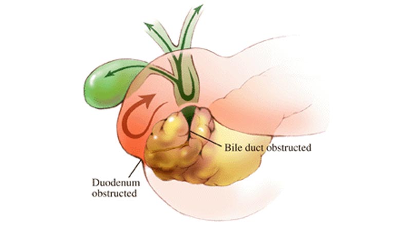 انسداد مجاری صفراوی