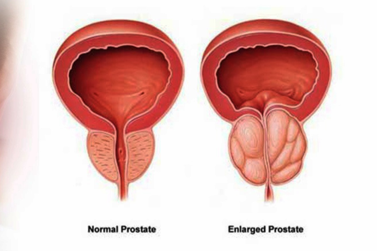 بزرگ شدن پروستات