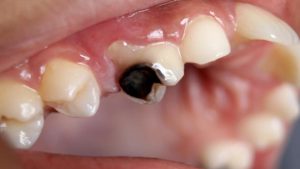 فرآورده های طبیعی برای پوسیدگی دندان