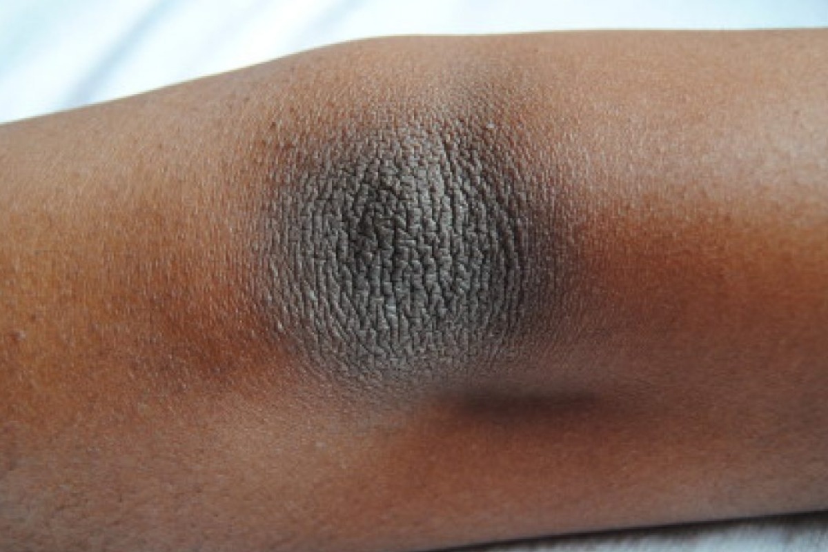 درمان روشن کننده آرنج و زانو