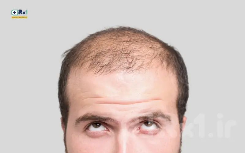 ریزش مو