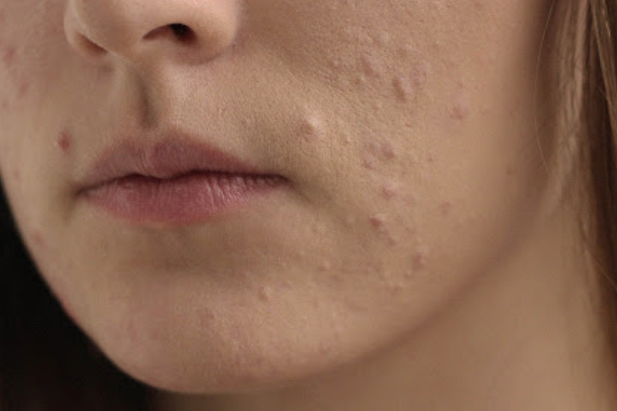 بهترین کرم ضد جوش برای نوجوانان: انتخابی مطمئن برای پوستی شفاف