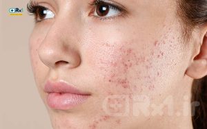 بهترین آبرسان پوست چرب و جوش دار