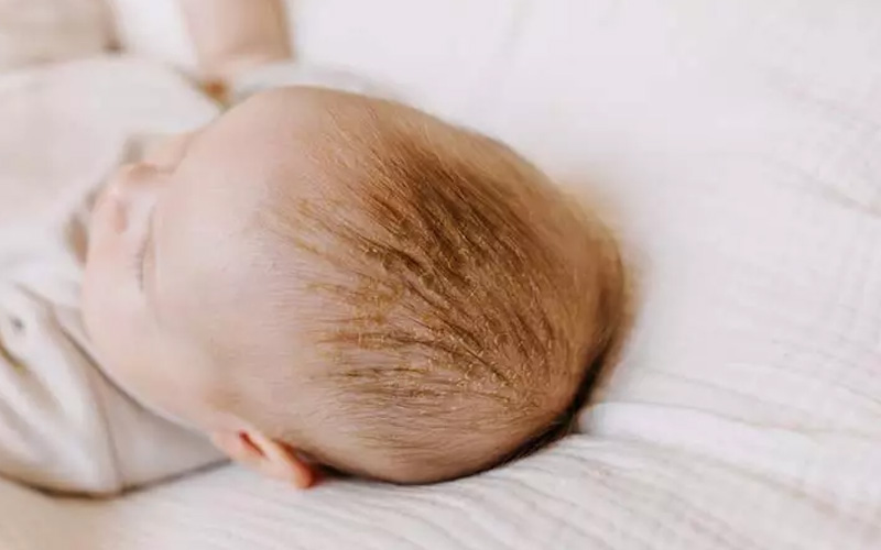 شوره سر نوزادان