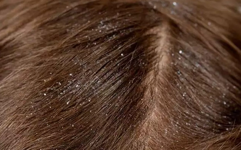 شوره سر کودکان