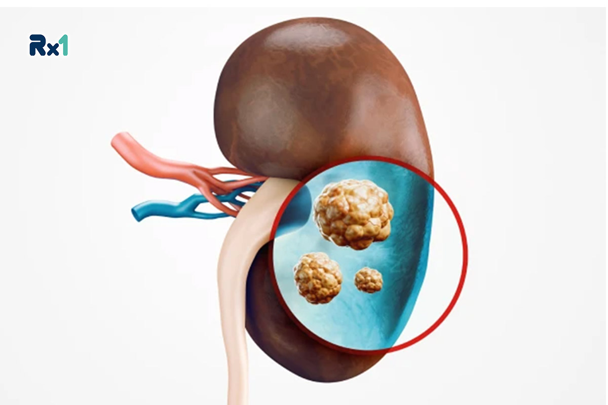 قرص کلسیم و عوارض آن برای کلیه؛ چطور از رسوب کلسیم ‏در کلیه جلوگیری کنیم؟