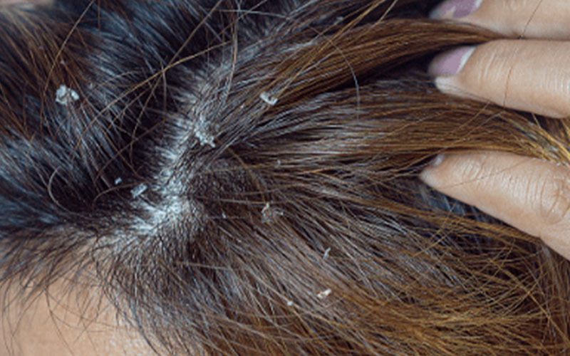 معرفی بهترین شامپوهای ضد شوره مناسب موهای خشک 