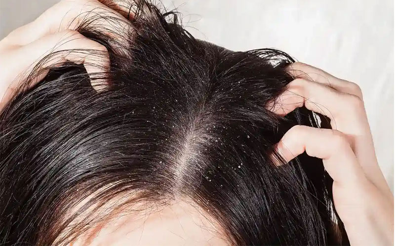 شامپو ضد شوره زنانه