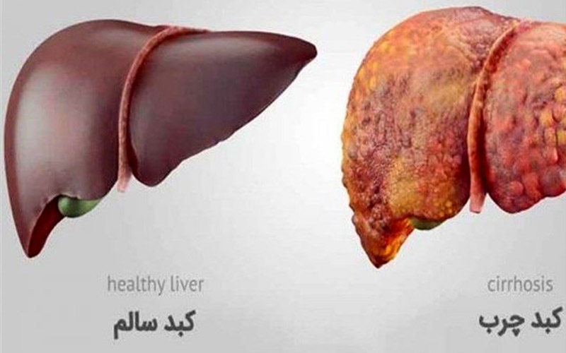 بیماری کبد چرب چیست