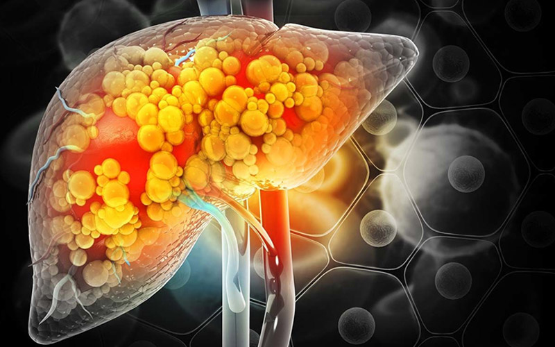 بیماری کبد چرب