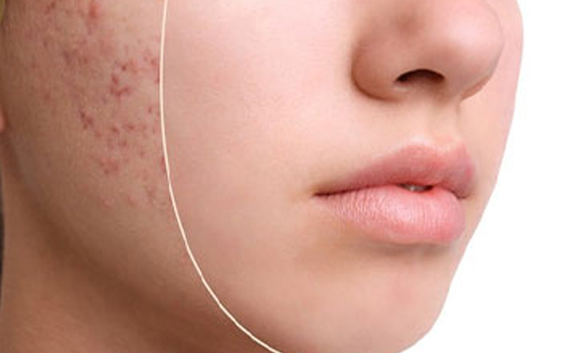 ترمیم کننده جای جوش