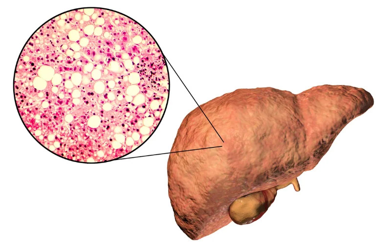 کبد چرب چیست