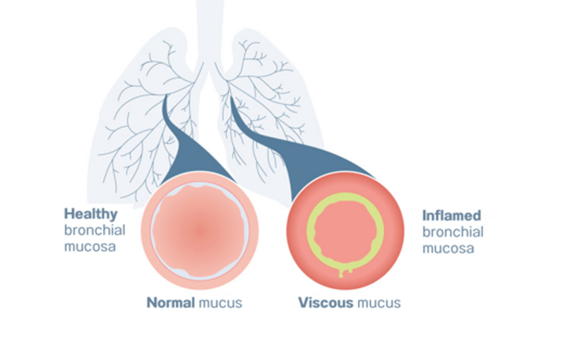 علت سرفه خلط دار