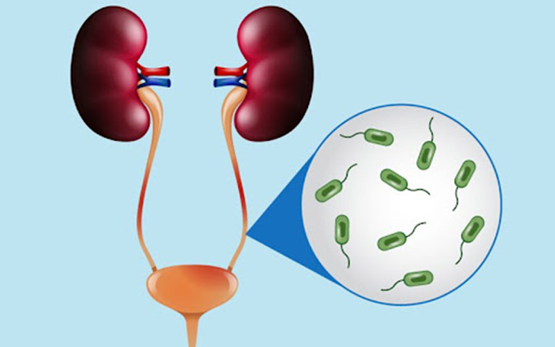 عفونت ادراری