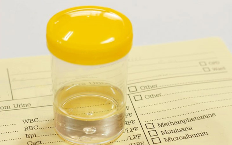 آزمایش ادرار چیست