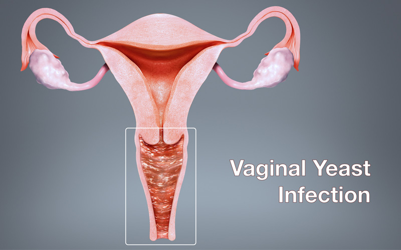 لاکتوفم و عفونت واژن