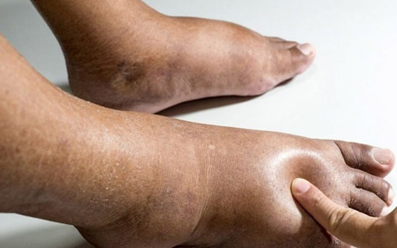 تورم پاها در کبد چرب 