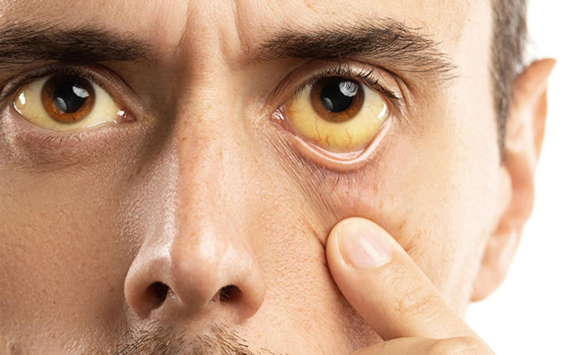 علائم کبد چرب