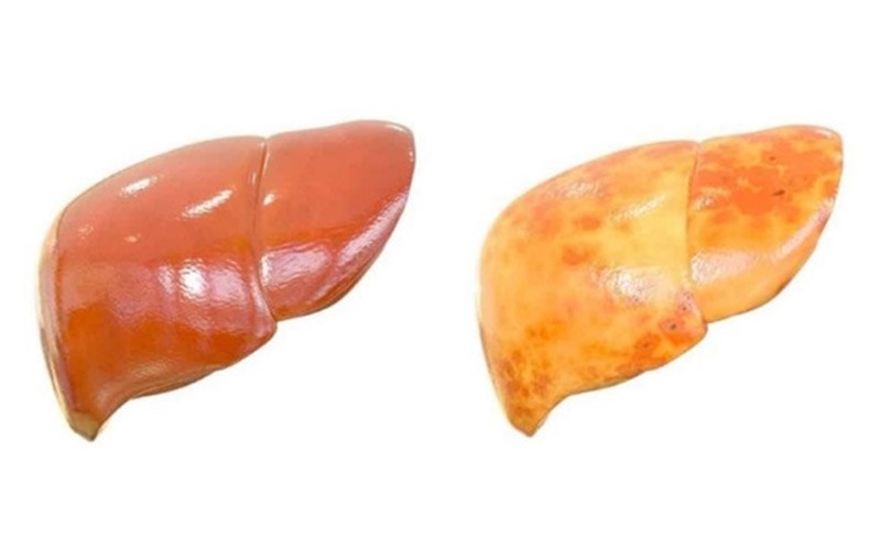 انواع کبد چرب