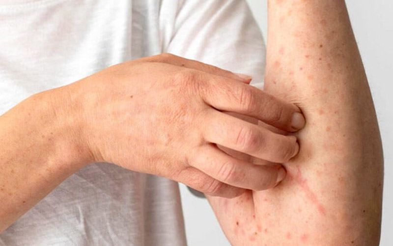 علائم کبد چرب چیست