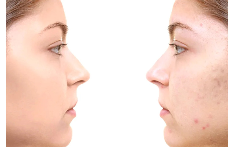 درمان جوش صورت با پماد کلیندامایسین
