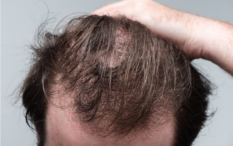ریزش مو در مردان