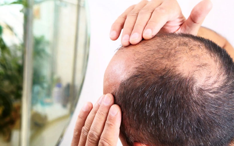 علل ریزش مو