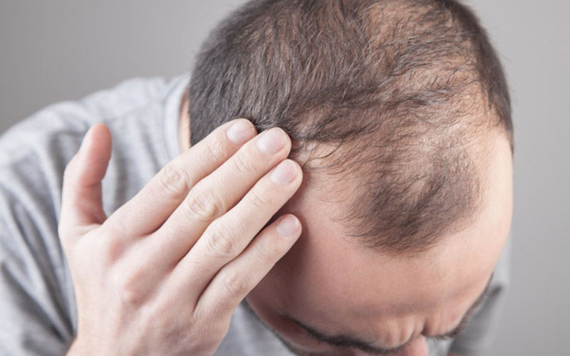 ریزش مو مردانه