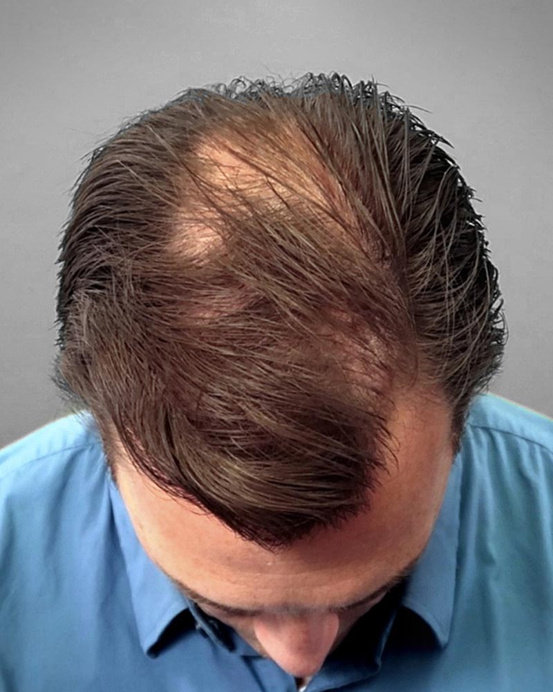 ریزش مو در مردان