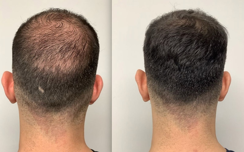 علت ریزش مو