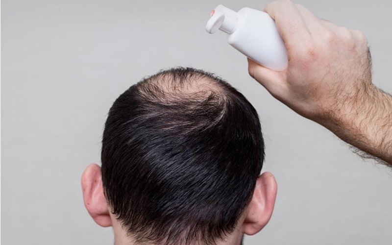 بهترین شامپو ضد ریزش مو