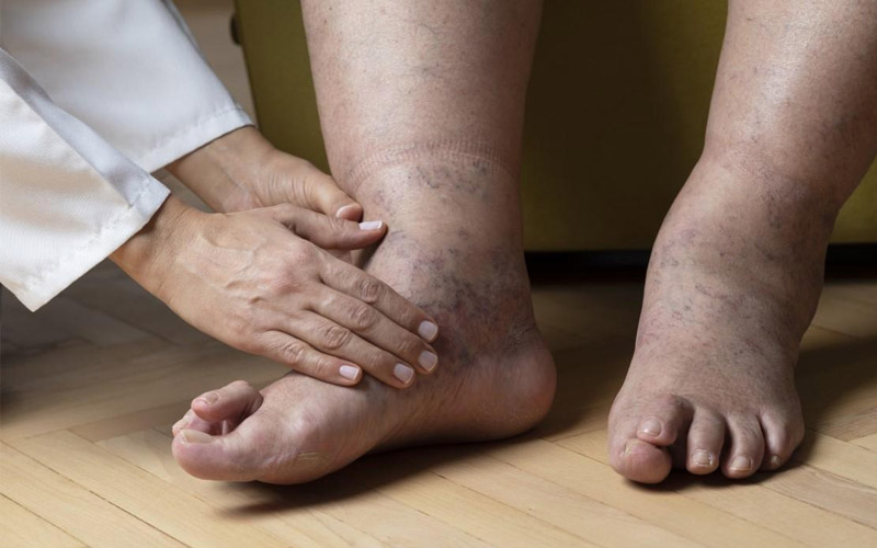 عوارض دیابت